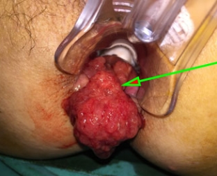 Polyp trực tràng